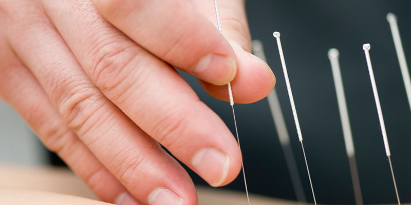 Common Myths About Acupuncture