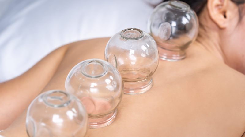 What is Cupping Therapy and Is It Right For You?